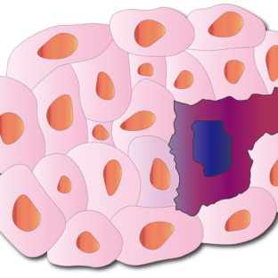 松葉がガンに効果あり?!イタリア人医師による「ガンの新しい治療法」